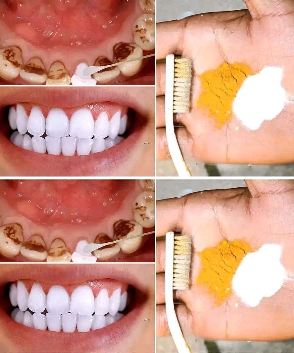 Blanchiment dentaire à domicile : obtenez des dents plus blanches en seulement 2 minutes !