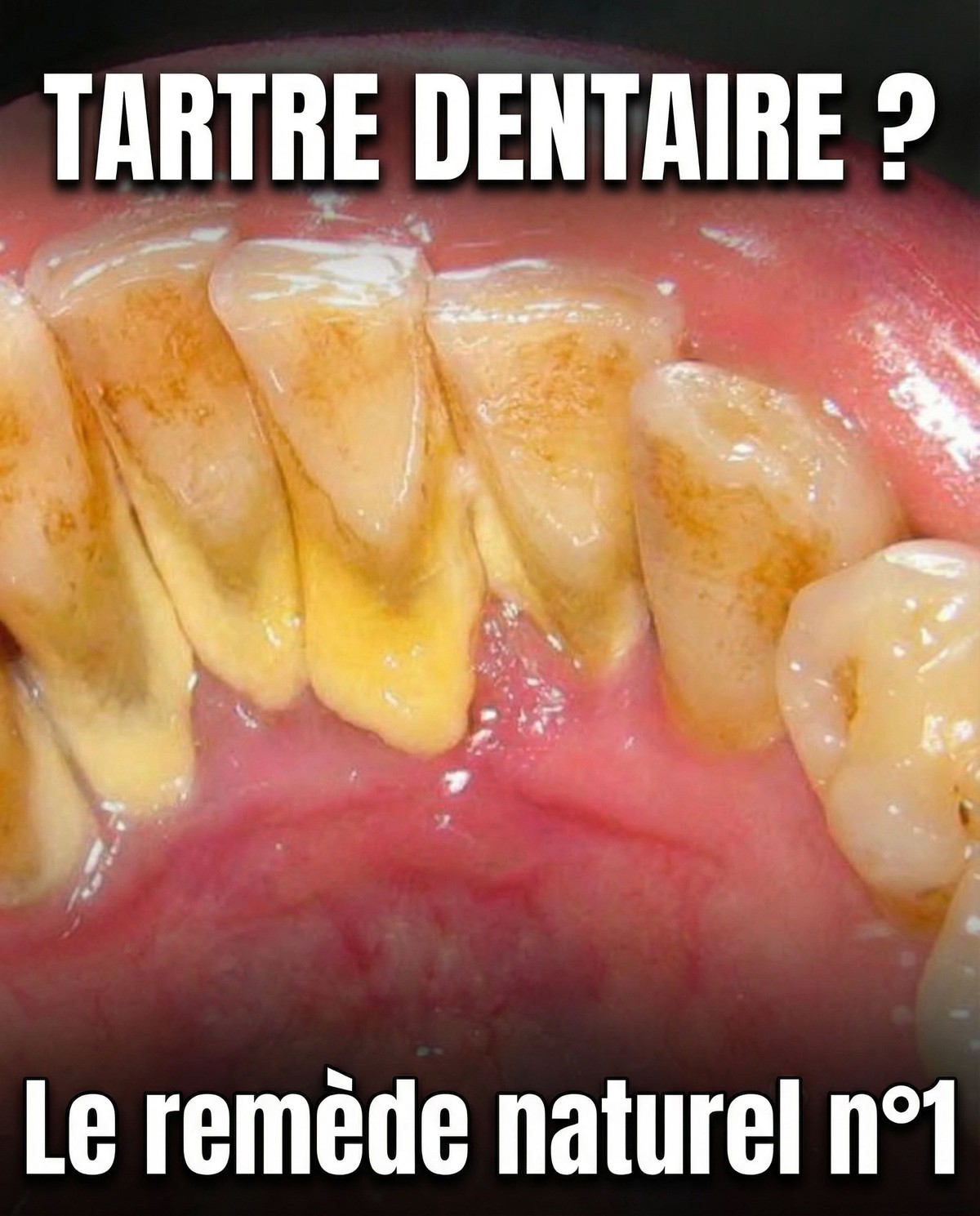 Le remède numéro 1 pour la plaque dentaire (tartre)
