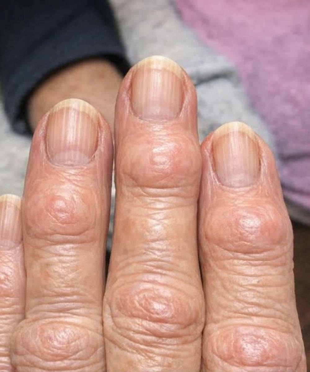 Ma grand-mère a des petites bosses dures qui se forment sur les articulations de ses doigts, près des ongles. Pourquoi cela se propage-t-il ?