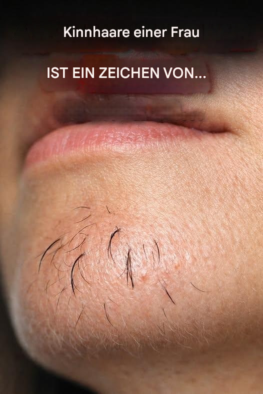 Les poils au menton chez les femmes sont un signe de… Afficher plus