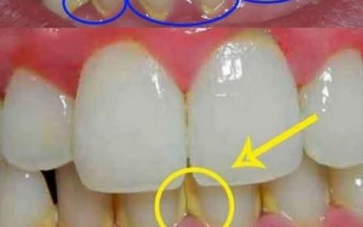 ENLEVEZ LA PLAQUE DENTAIRE EN 5 MINUTES : MÉTHODES NATURELLES POUR RETROUVER DES DENTS PLUS PROPRES