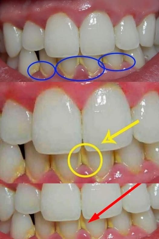 ENLEVEZ LA PLAQUE DENTAIRE EN 5 MINUTES : MÉTHODES NATURELLES POUR RETROUVER DES DENTS PLUS PROPRES